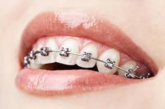 Traditional Braces